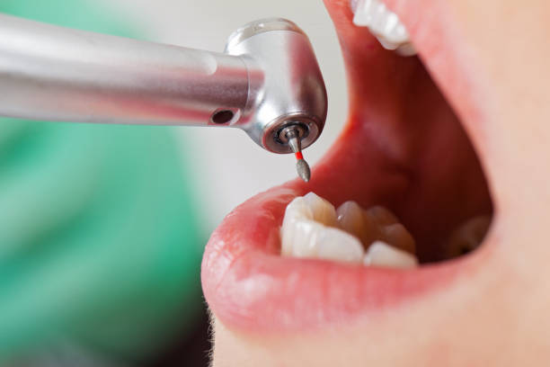 Best Emergency Tooth Extraction in Questa, NM